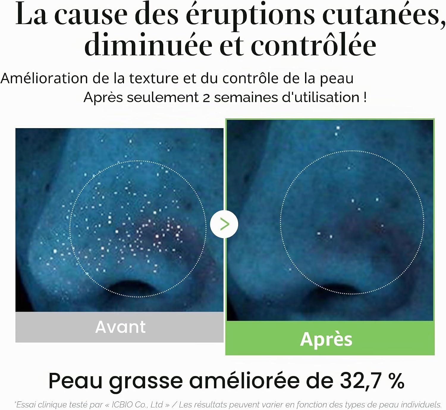 Comparatif avant après montrant la réduction visible des rougeurs et l'apaisement d'une peau sensible grâce au toner aux exosomes de Cica Medicube.