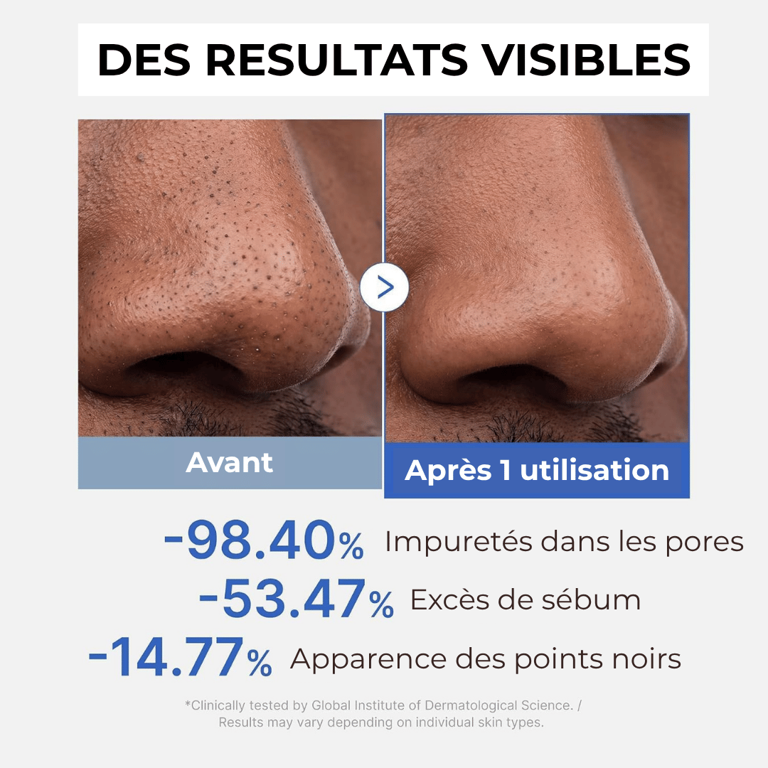 résultats sur le nez